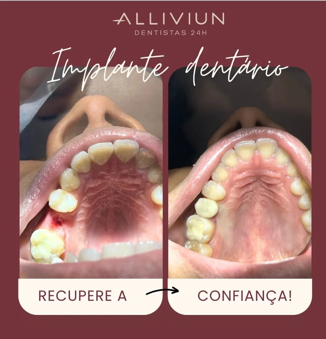 Antes e depois de implante dentário — recupere a confiança