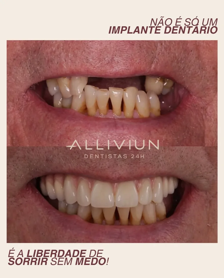 Antes e depois de implante dentário — a liberdade de sorrir sem medo