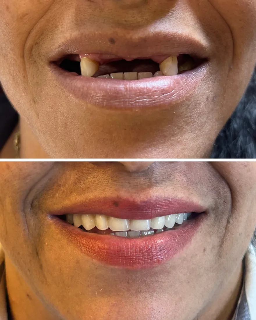 Antes e depois de um tratamento de implante dentário