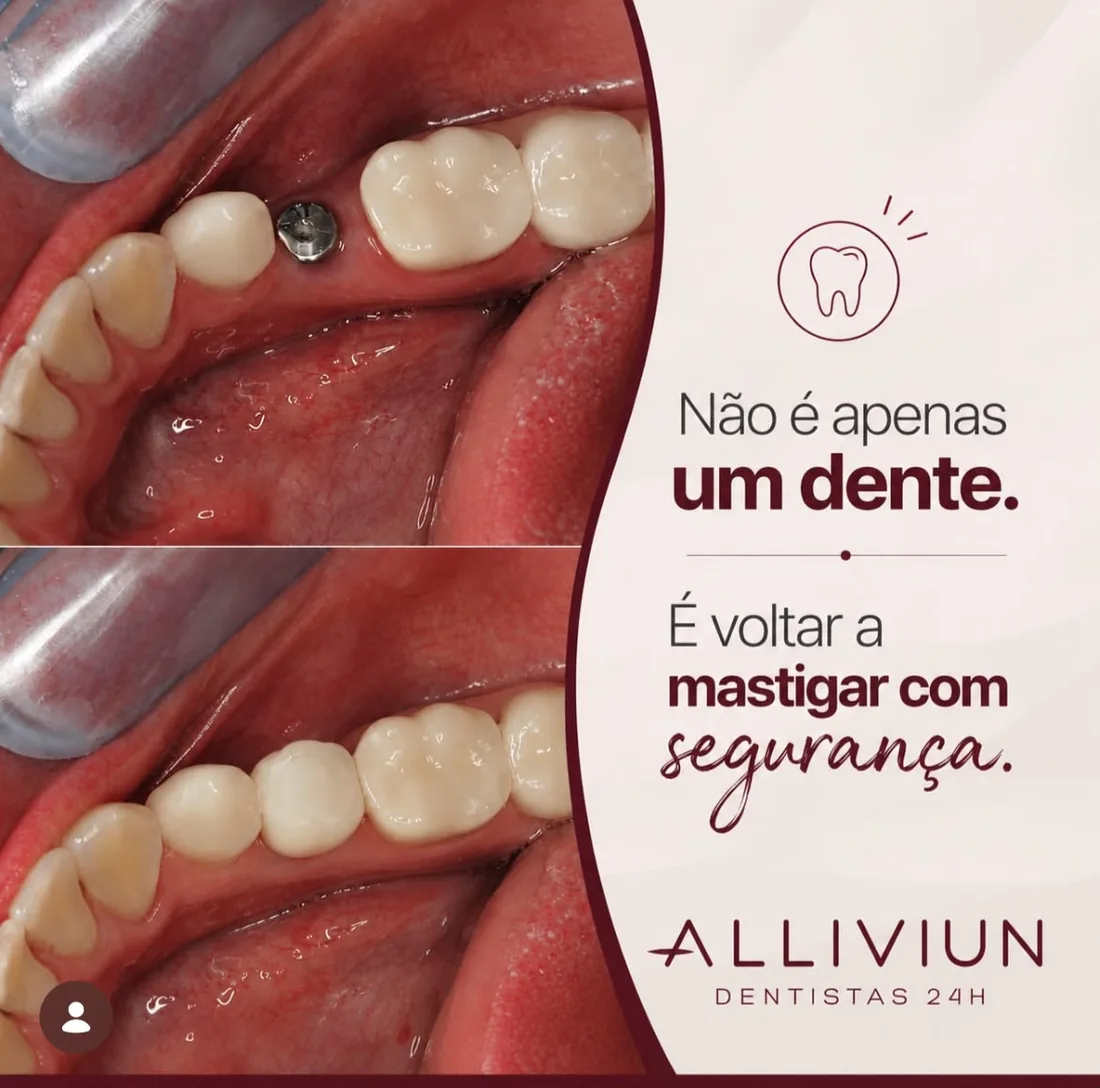 Antes e depois de implante dentário — voltar a mastigar com segurança