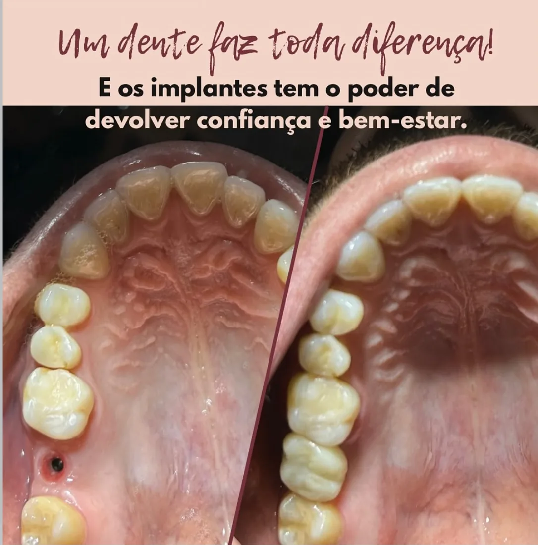 Antes e depois de implante dentário — um dente faz toda diferença